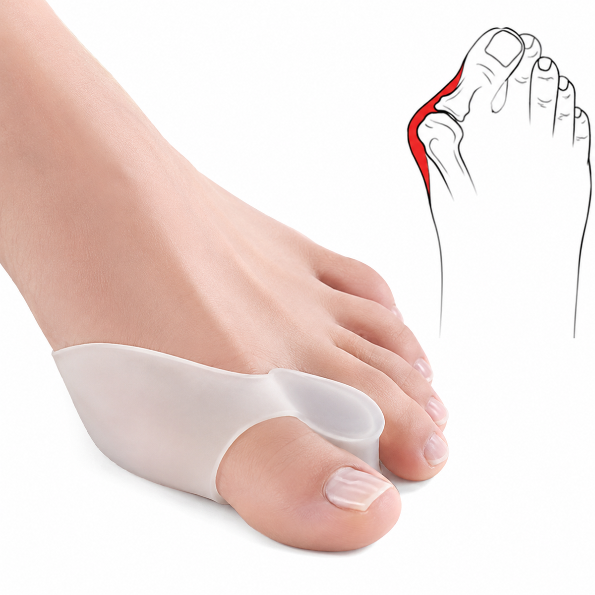 Correcteur d’oignon orthopédique