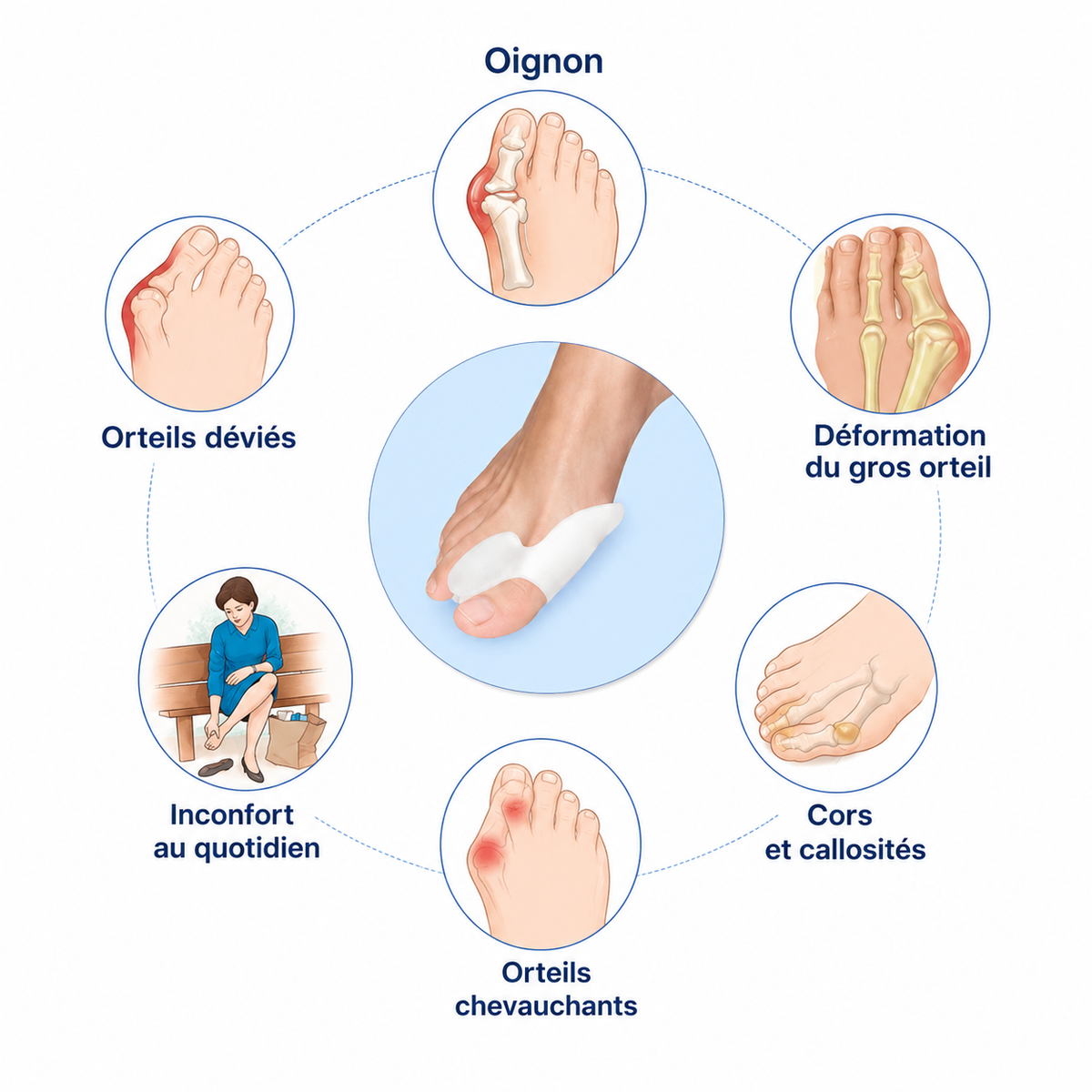 Correcteur d’oignon orthopédique
